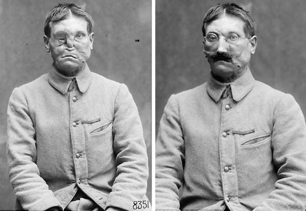 Истоки пластической хирургии: как скульпторы спасали изуродованных ветеранов Первой мировой войны Ветеранов Первой мировой с поврежденными лицами называли самыми трагическими жертвами войны они